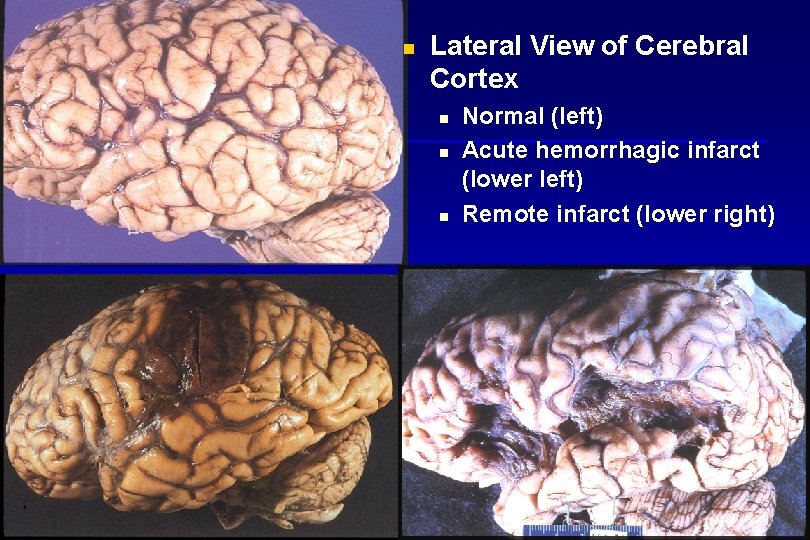 n Lateral View of Cerebral Cortex n n n Normal (left) Acute hemorrhagic infarct