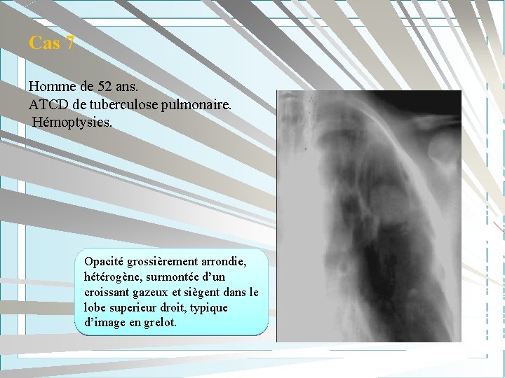 Cas 7 Homme de 52 ans. ATCD de tuberculose pulmonaire. Hémoptysies. Opacité grossièrement arrondie,