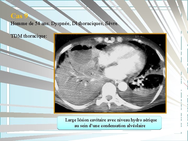 Cas 9 Homme de 54 ans. Dyspnée, Dl thoraciques, fièvre. TDM thoracique: Large lésion