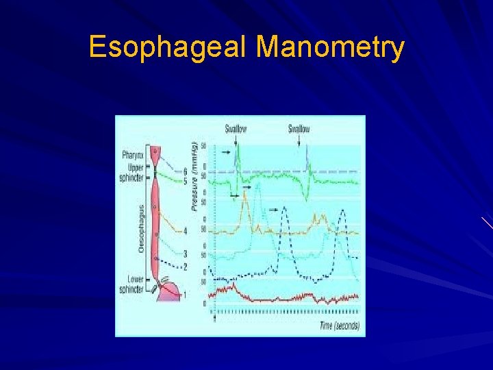Esophageal Manometry Esophageal Manometry