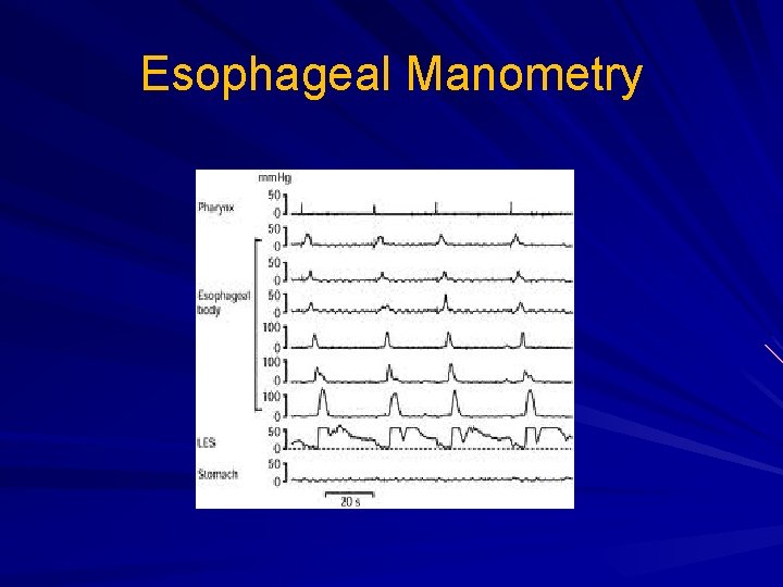 Esophageal Manometry 
