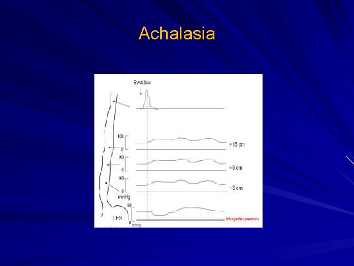 Achalasia Achalasia