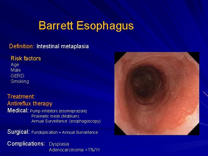 Barrett Esophagus Definition: Intestinal metaplasia Risk factors Age Male GERD Smoking Treatment: Antireflux therapy