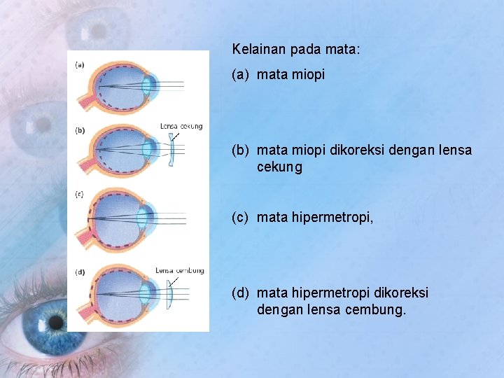 Kelainan pada mata: (a) mata miopi (b) mata miopi dikoreksi dengan lensa cekung (c)