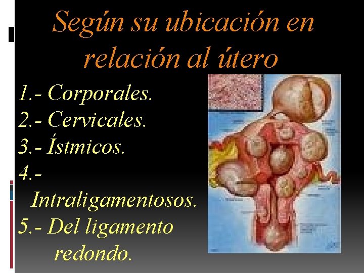 Según su ubicación en relación al útero 1. - Corporales. 2. - Cervicales. 3.