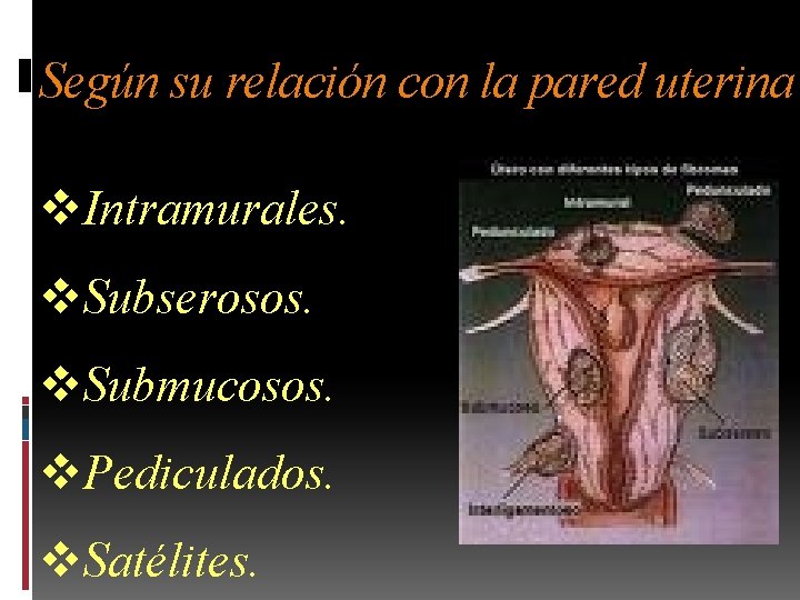 Según su relación con la pared uterina v. Intramurales. v. Subserosos. v. Submucosos. v.