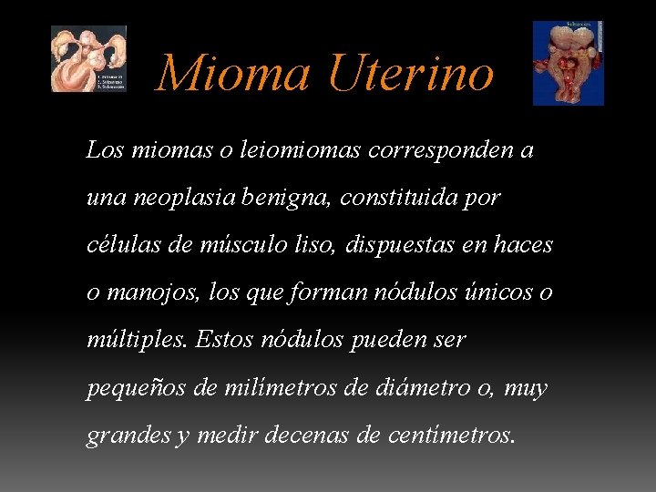 Mioma Uterino Los miomas o leiomiomas corresponden a una neoplasia benigna, constituida por células