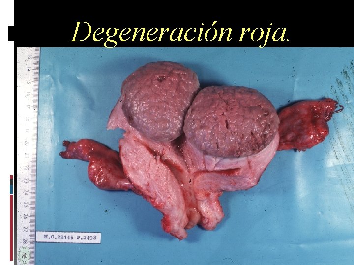 Degeneración roja. 