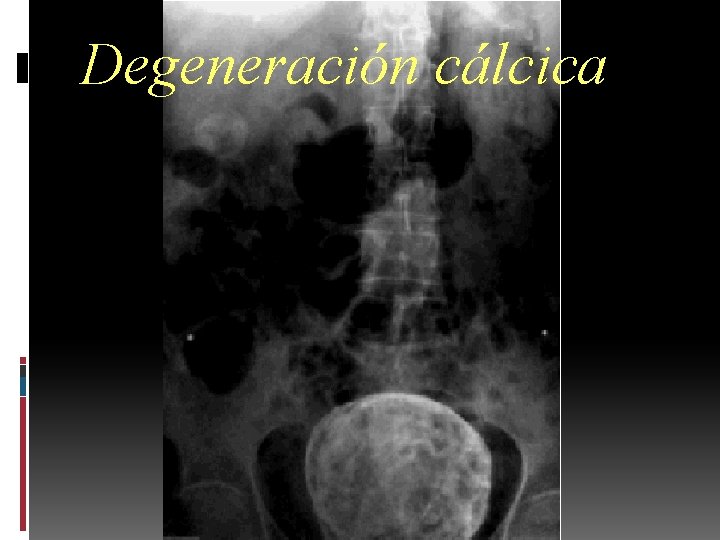 Degeneración cálcica 