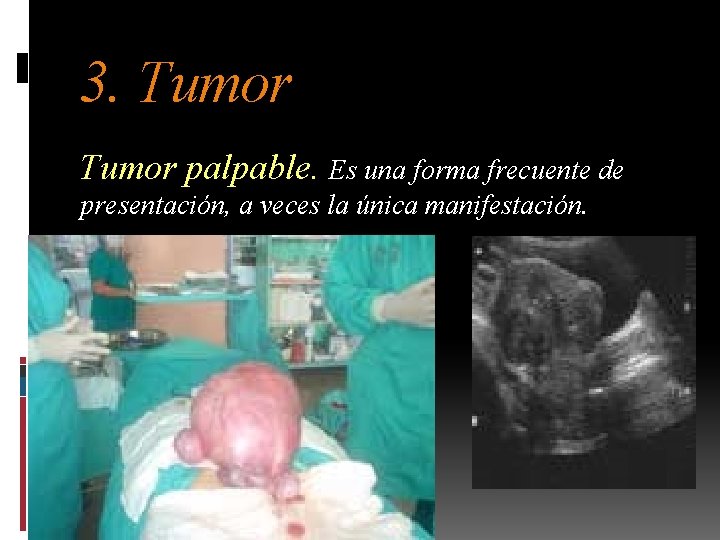 3. Tumor palpable. Es una forma frecuente de presentación, a veces la única manifestación.