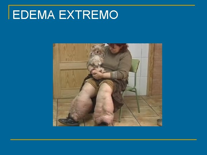 EDEMA EXTREMO 