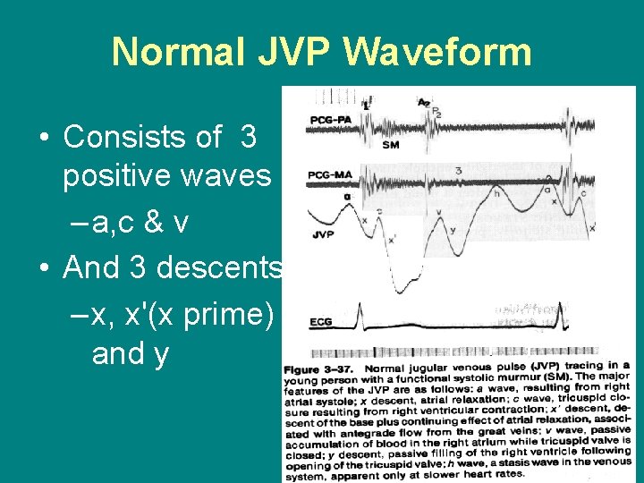 Normal JVP Waveform • Consists of 3 positive waves – a, c & v