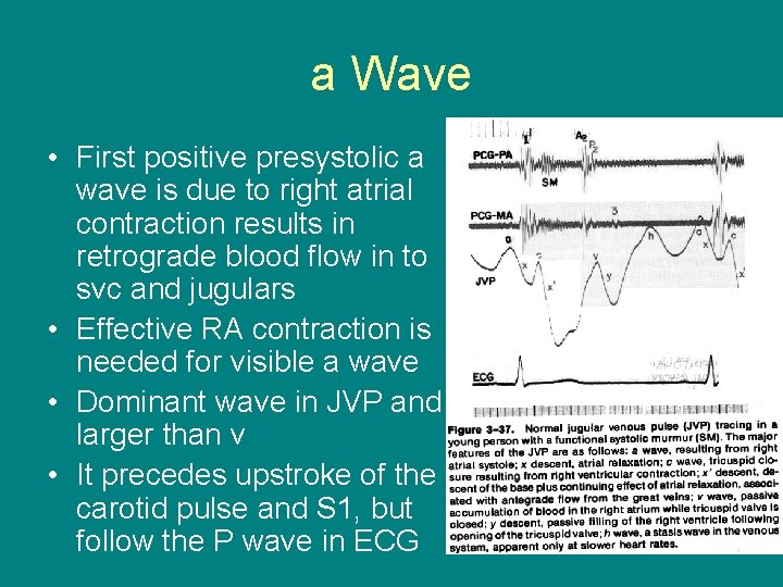 a Wave • First positive presystolic a wave is due to right atrial contraction