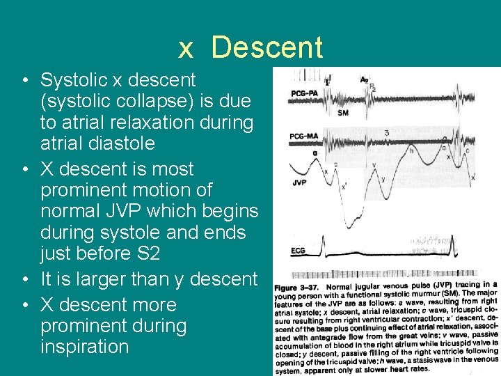 x Descent • Systolic x descent (systolic collapse) is due to atrial relaxation during