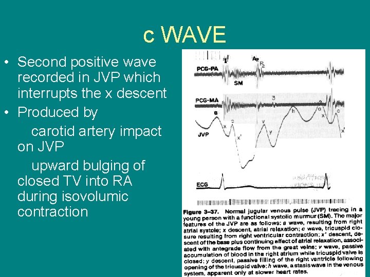 c WAVE • Second positive wave recorded in JVP which interrupts the x descent