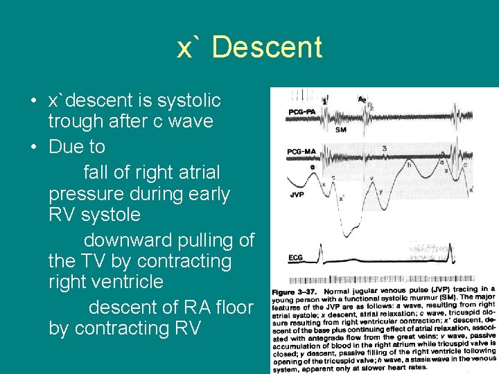 x` Descent • x`descent is systolic trough after c wave • Due to fall