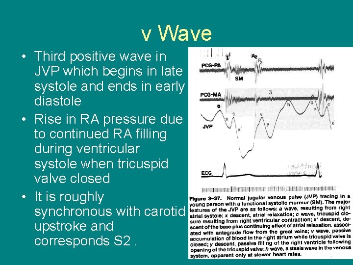 v Wave • Third positive wave in JVP which begins in late systole and