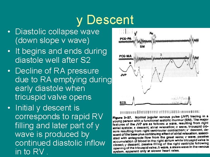 y Descent • Diastolic collapse wave (down slope v wave) • It begins and