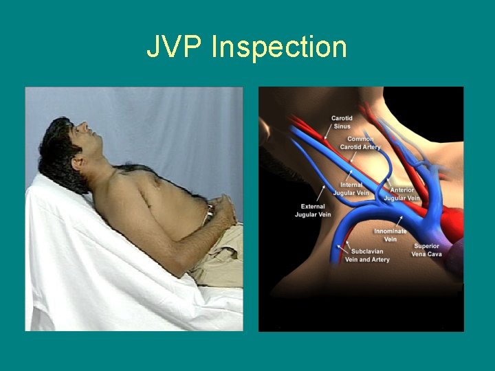 JVP Inspection 