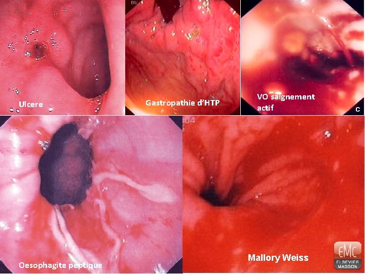 Ulcere Oesophagite peptique Gastropathie d’HTP VO saignement actif Mallory Weiss 