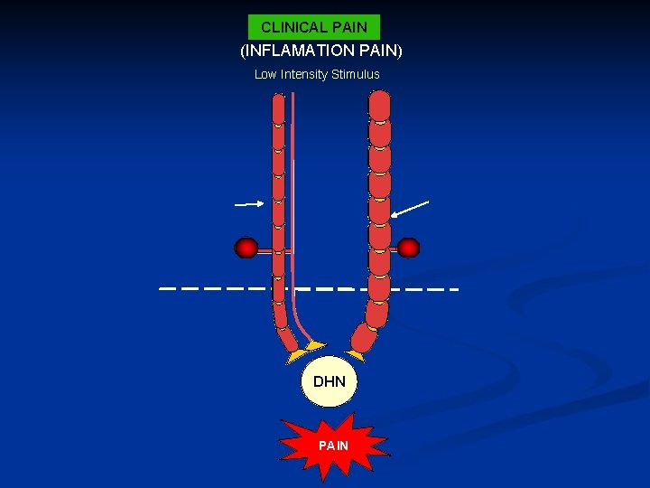 CLINICAL PAIN (INFLAMATION PAIN) Low Intensity Stimulus Ab Fiber Ad Fiber PNS CNS DHN