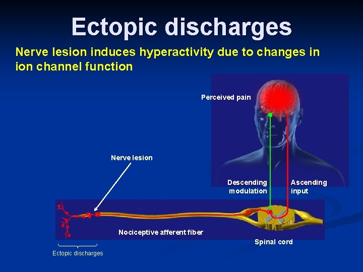 Ectopic discharges Nerve lesion induces hyperactivity due to changes in ion channel function Perceived