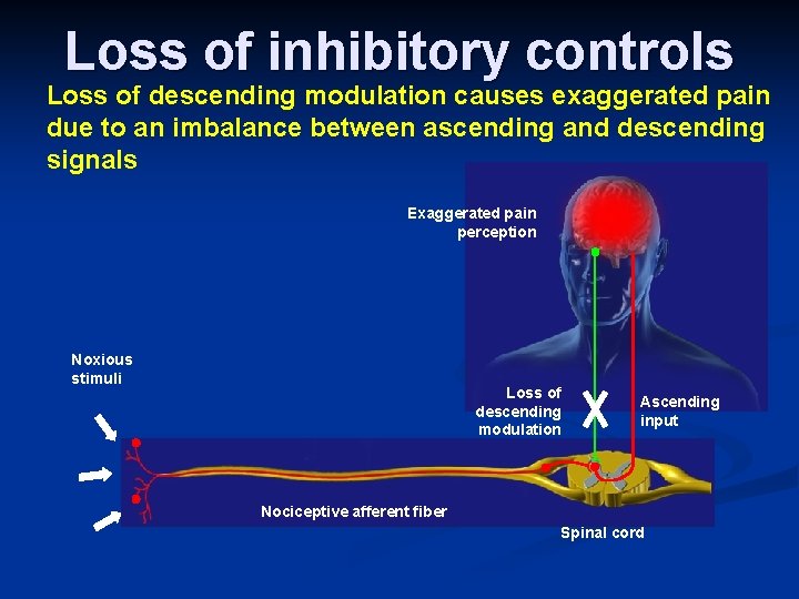 Loss of inhibitory controls Loss of descending modulation causes exaggerated pain due to an