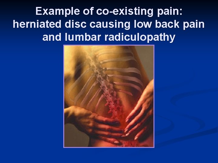 Example of co-existing pain: herniated disc causing low back pain and lumbar radiculopathy 