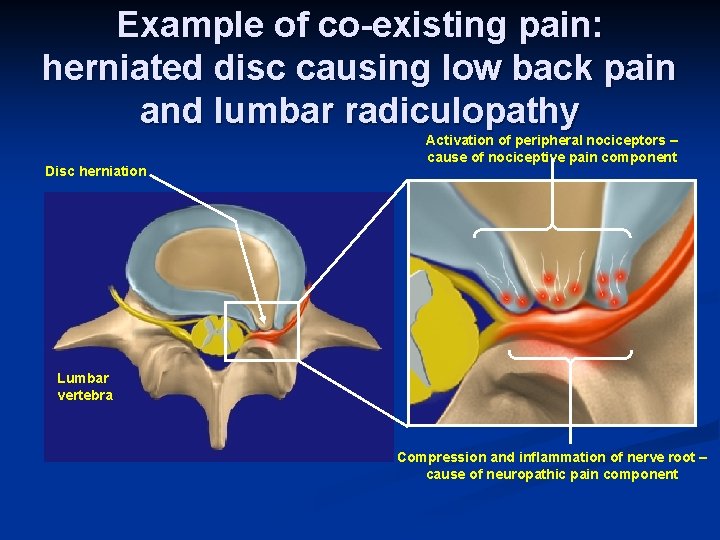 Example of co-existing pain: herniated disc causing low back pain and lumbar radiculopathy Disc