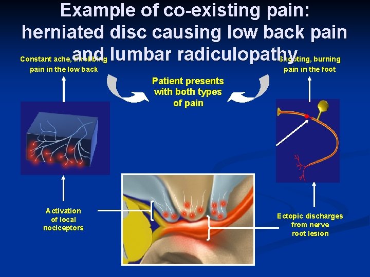 Example of co-existing pain: herniated disc causing low back pain and lumbar radiculopathy Constant