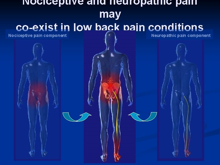 Nociceptive and neuropathic pain may co-exist in low back pain conditions Nociceptive pain component