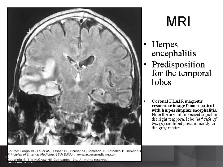 MRI • Herpes encephalitis • Predisposition for the temporal lobes • Coronal FLAIR magnetic