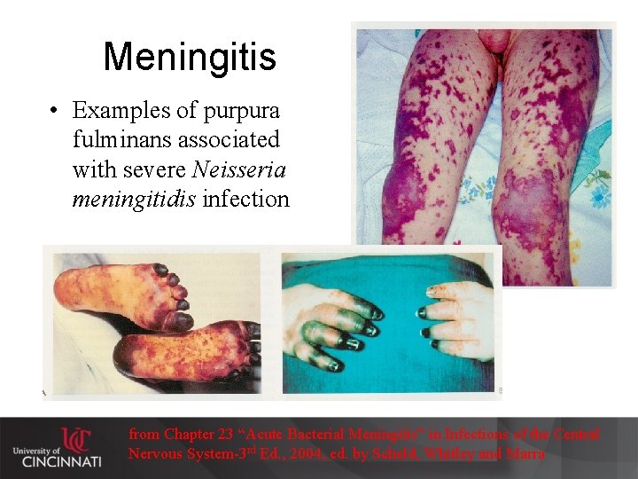 Meningitis • Examples of purpura fulminans associated with severe Neisseria meningitidis infection from Chapter