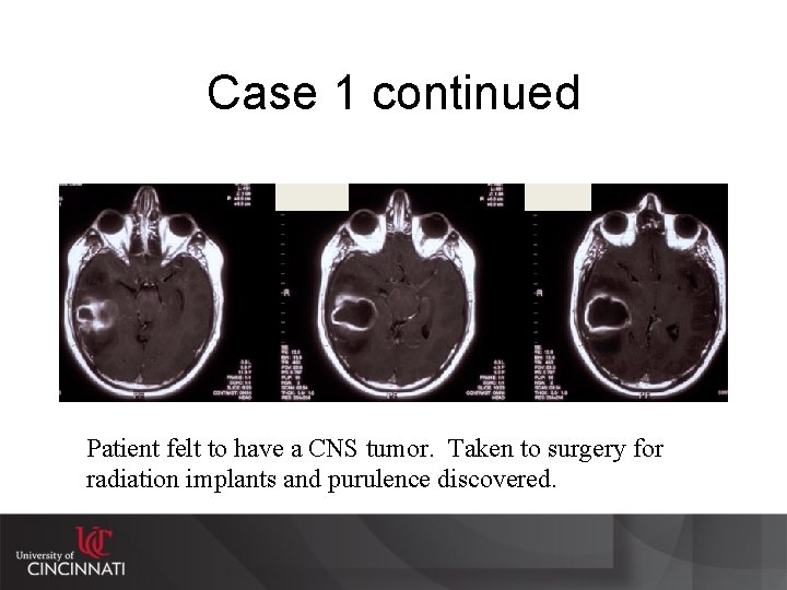 Case 1 continued Patient felt to have a CNS tumor. Taken to surgery for
