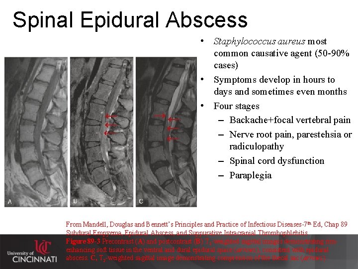 Spinal Epidural Abscess • Staphylococcus aureus most common causative agent (50 -90% cases) •