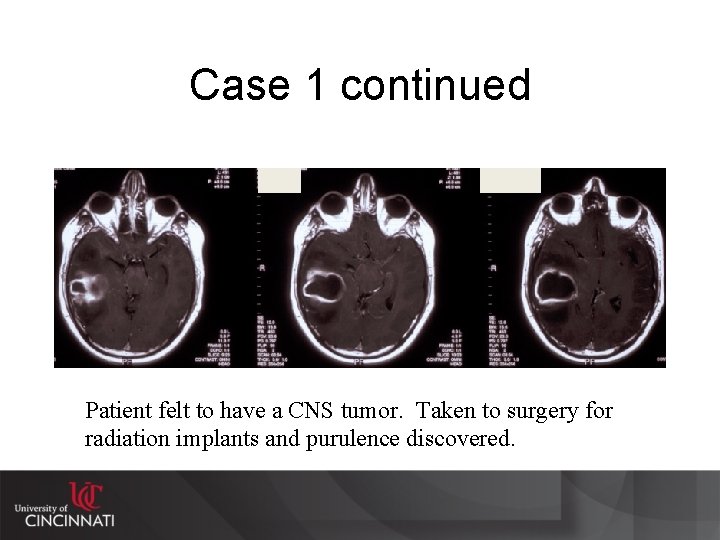 Case 1 continued Patient felt to have a CNS tumor. Taken to surgery for