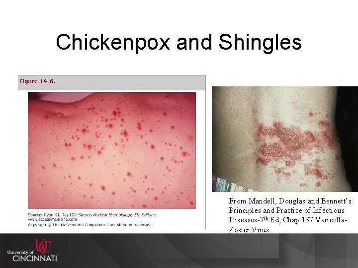 Chickenpox and Shingles From Mandell, Douglas and Bennett’s Principles and Practice of Infectious Diseases-7