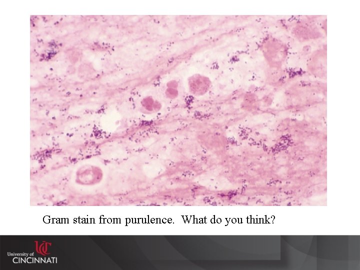 Gram stain from purulence. What do you think? 