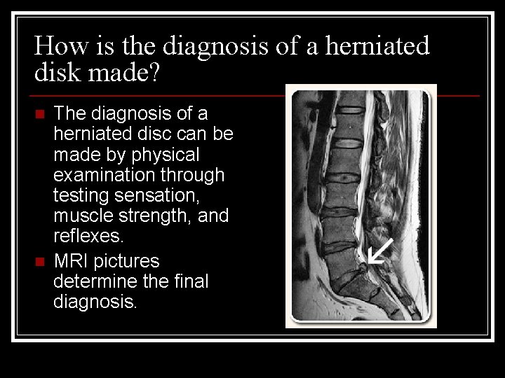 How is the diagnosis of a herniated disk made? n n The diagnosis of