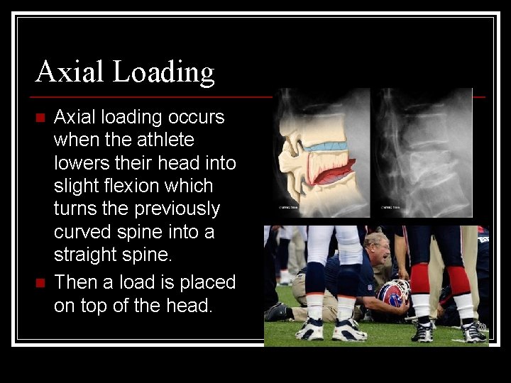Axial Loading n n Axial loading occurs when the athlete lowers their head into