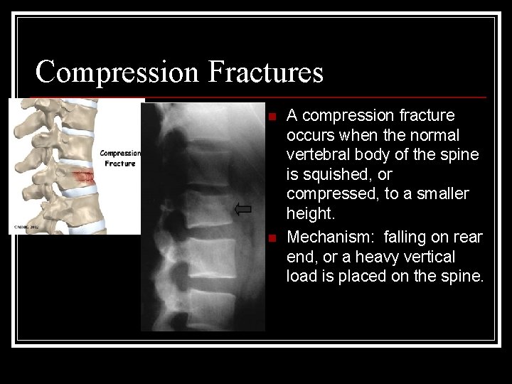 Compression Fractures n n A compression fracture occurs when the normal vertebral body of