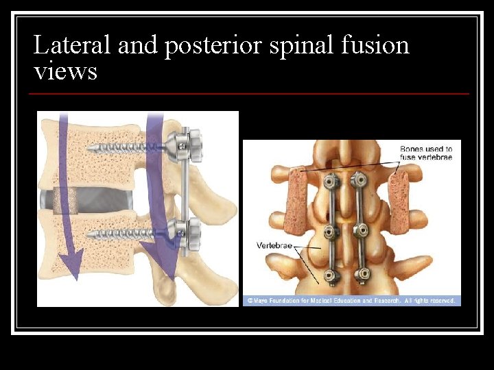 Lateral and posterior spinal fusion views 