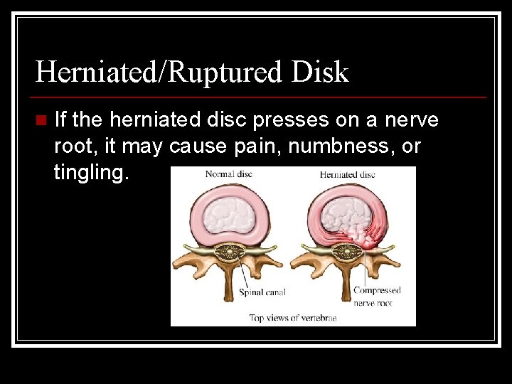 Herniated/Ruptured Disk n If the herniated disc presses on a nerve root, it may