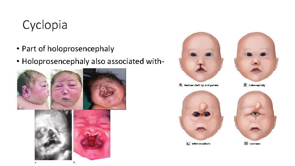 Cyclopia • Part of holoprosencephaly • Holoprosencephaly also associated with- 
