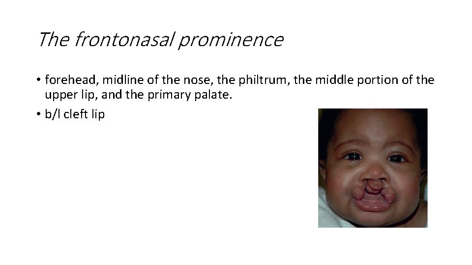 The frontonasal prominence • forehead, midline of the nose, the philtrum, the middle portion