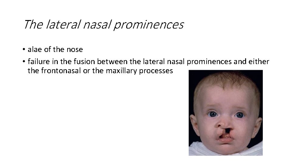 The lateral nasal prominences • alae of the nose • failure in the fusion