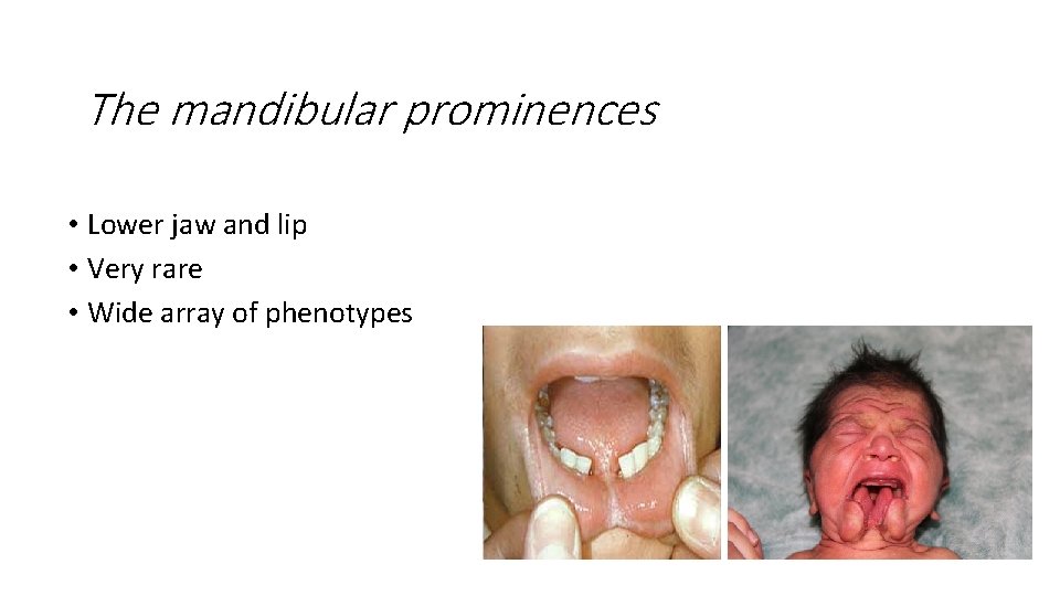 The mandibular prominences • Lower jaw and lip • Very rare • Wide array