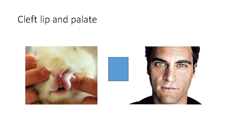 Cleft lip and palate 