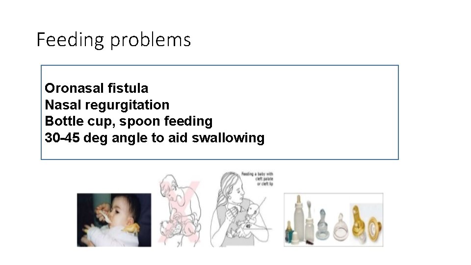 Feeding problems Oronasal fistula Nasal regurgitation Bottle cup, spoon feeding 30 -45 deg angle