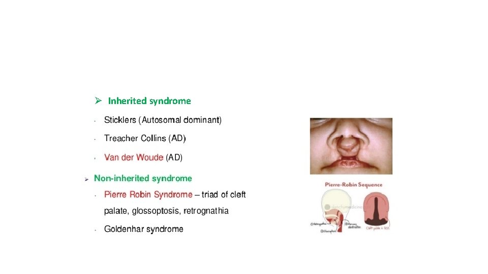 Ø Inherited syndrome 